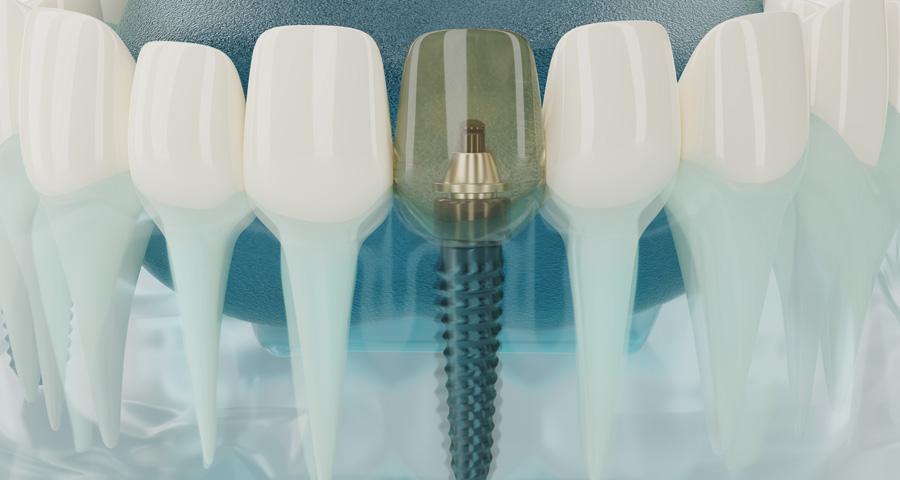O Que So Implantes Dentrios?